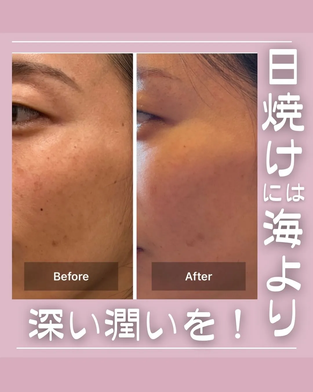 <鎌倉>日焼けと肌の水分量の関係！