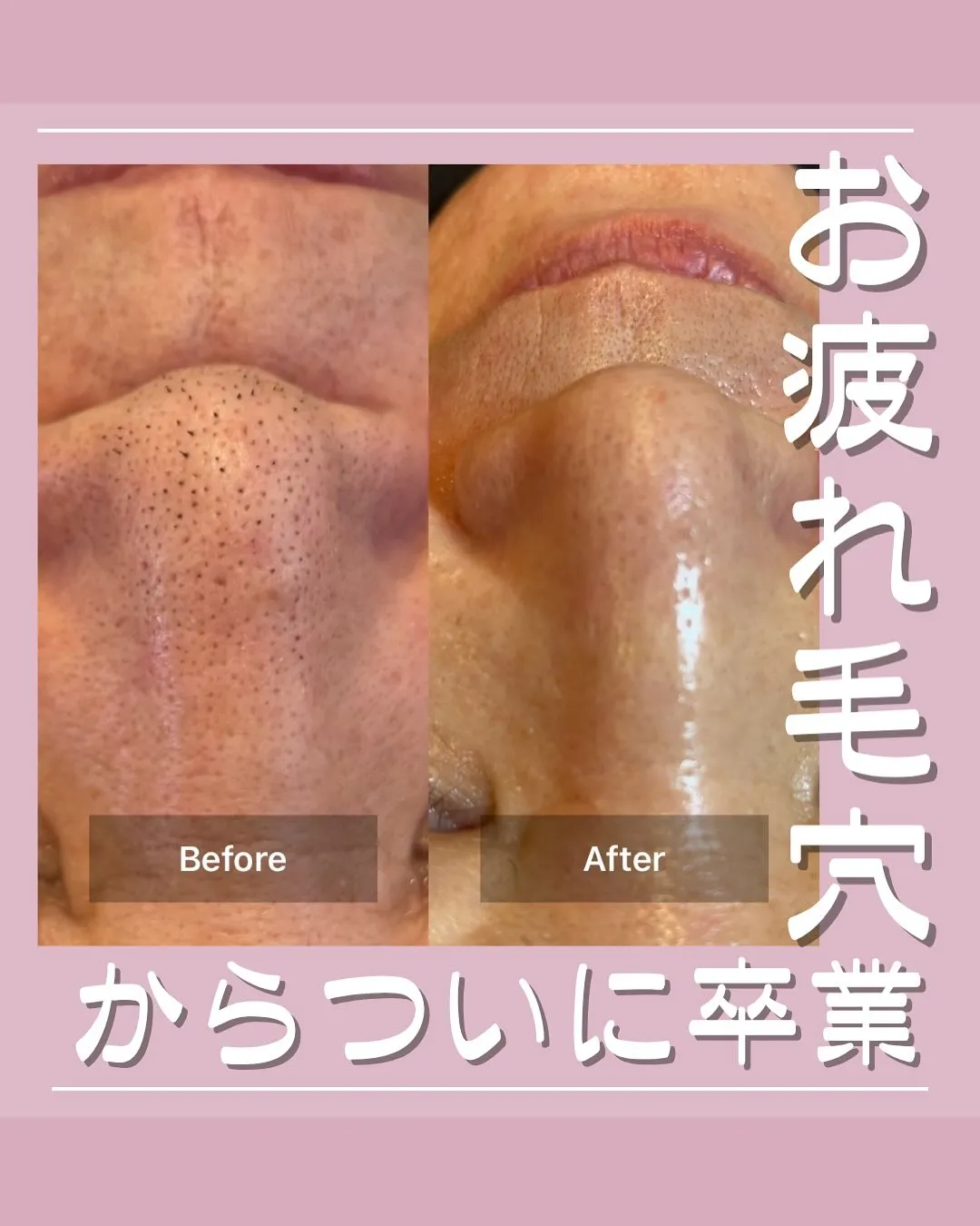 <鎌倉>お疲れ毛穴から卒業！