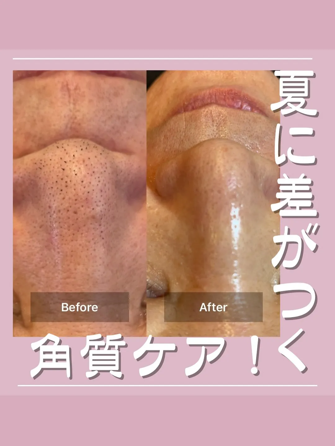 <鎌倉>夏に差がつく！角質ケア！