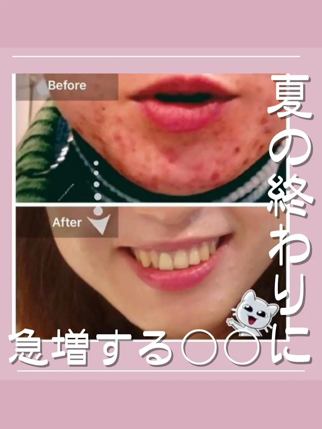 <鎌倉>夏の間に増えた皮脂や汗が毛穴を詰まらせてしまうことも...