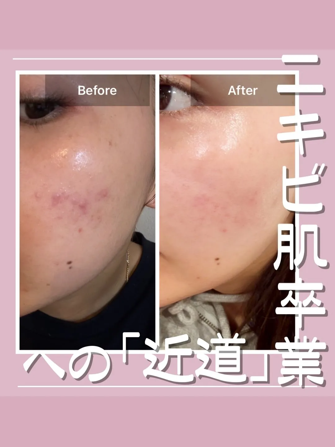 <鎌倉>ニキビ肌卒業への近道