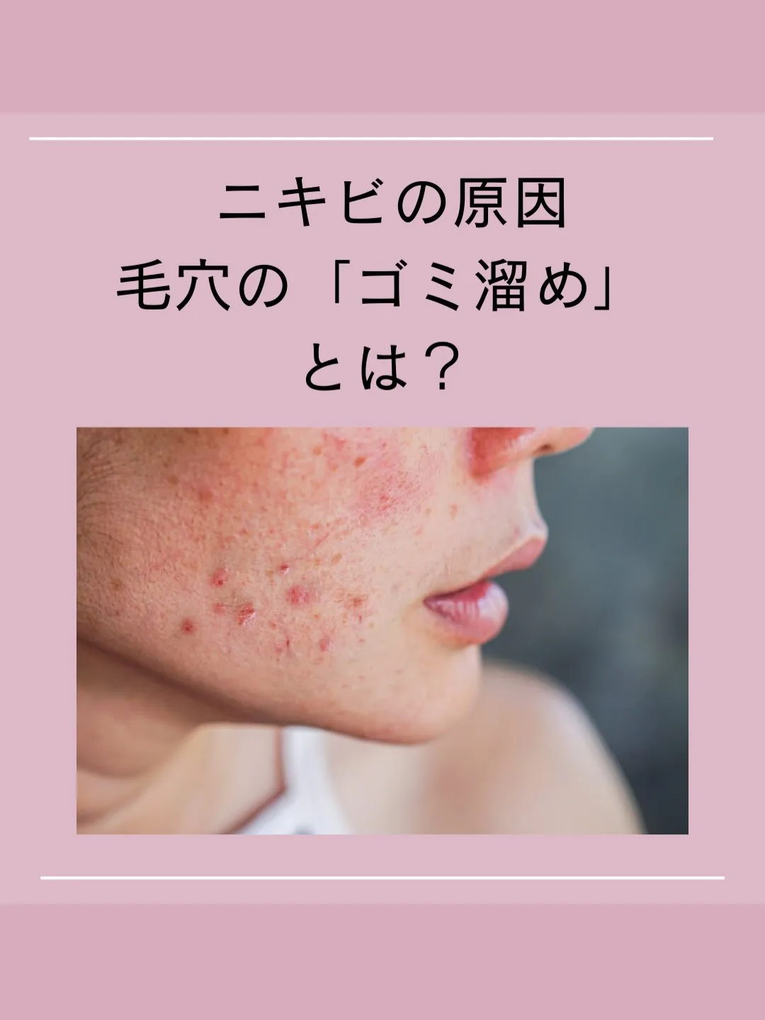 ニキビ肌卒業への近道