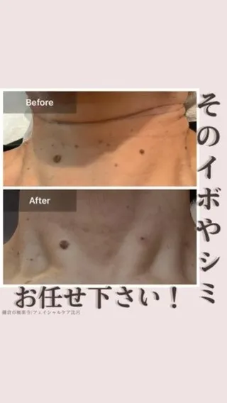 <鎌倉>そのイボやシミ、お任せ下さい！