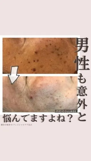 <鎌倉シミ取り>男性も意外と悩んでますよね？