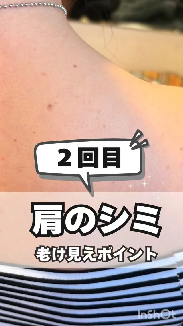 <鎌倉>肩のシミケア２回目