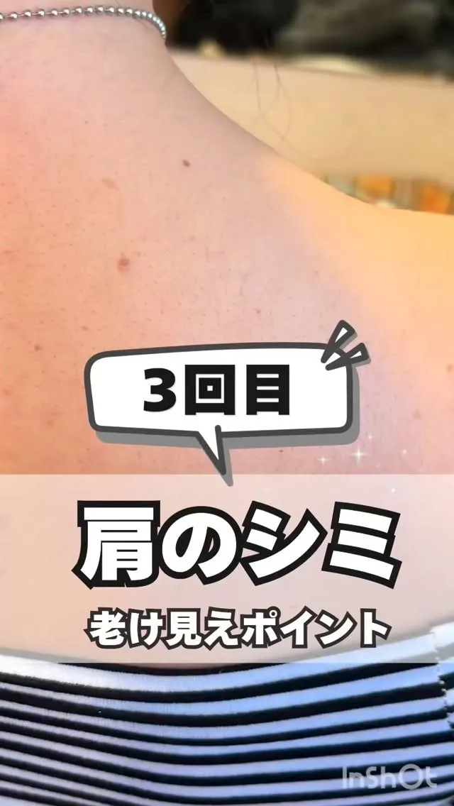 <鎌倉>肩のシミ３回目✨