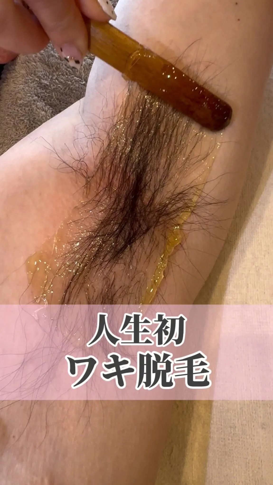 〈マツヤニ脇脱毛〉